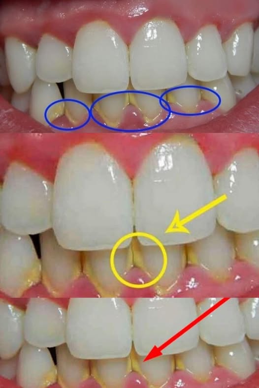 Remove plaque naturally in 5 minutes, without going to the dentist.