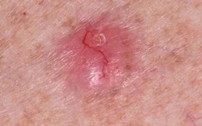 Basal cell carcinoma: what symptoms to look out for (1/2)