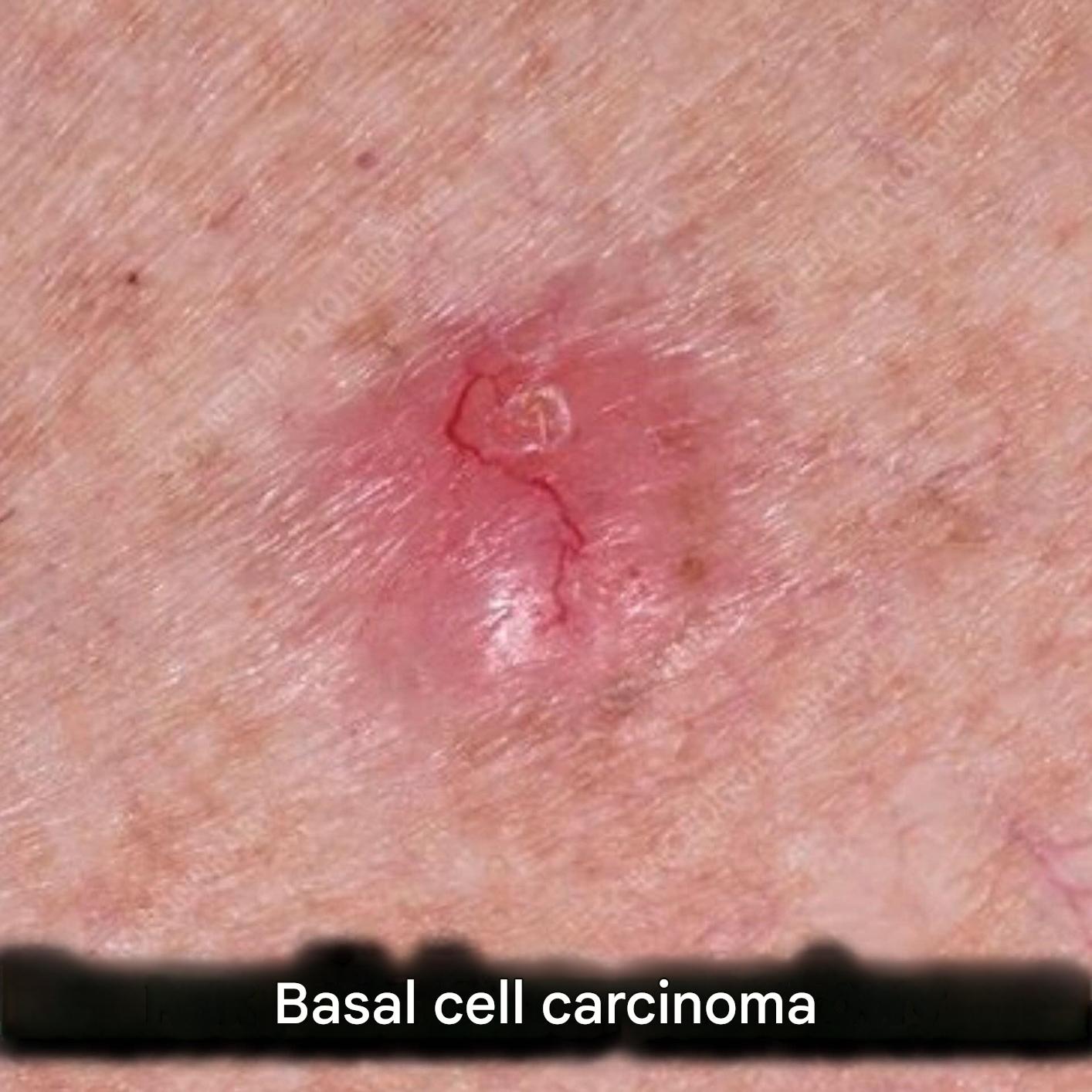Basal cell carcinoma: what symptoms to look out for (1/2)