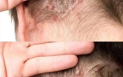 I found this on my son’s scalp. I have no idea what it is and we can’t get a doctor’s appointment right now. Do you have any advice?