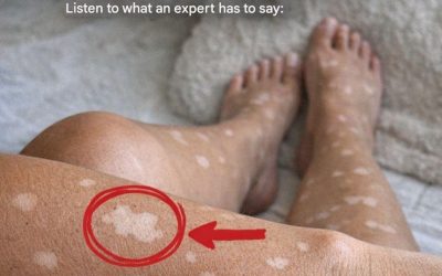 Why do white spots appear on nails?
