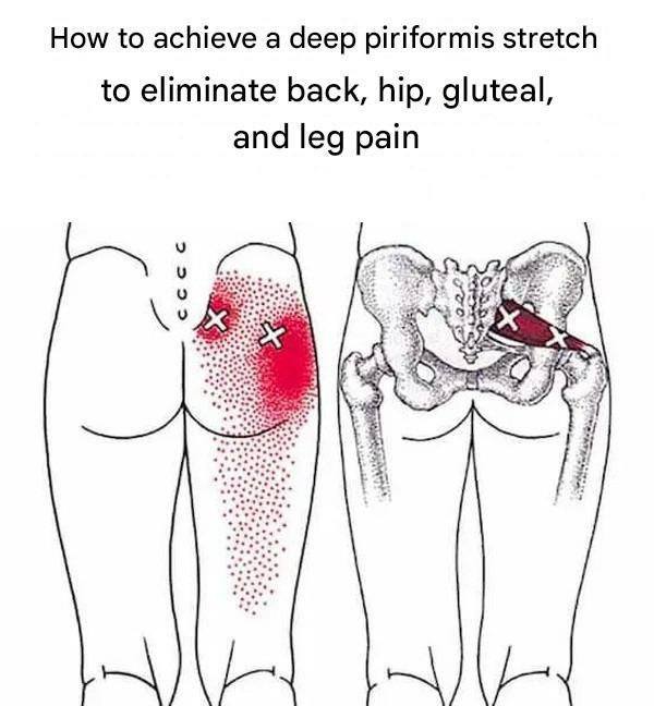 Piriformis Stretches to Relieve Piriformis Syndrome