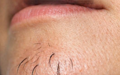 Chin hair on a woman is a sign of…See more