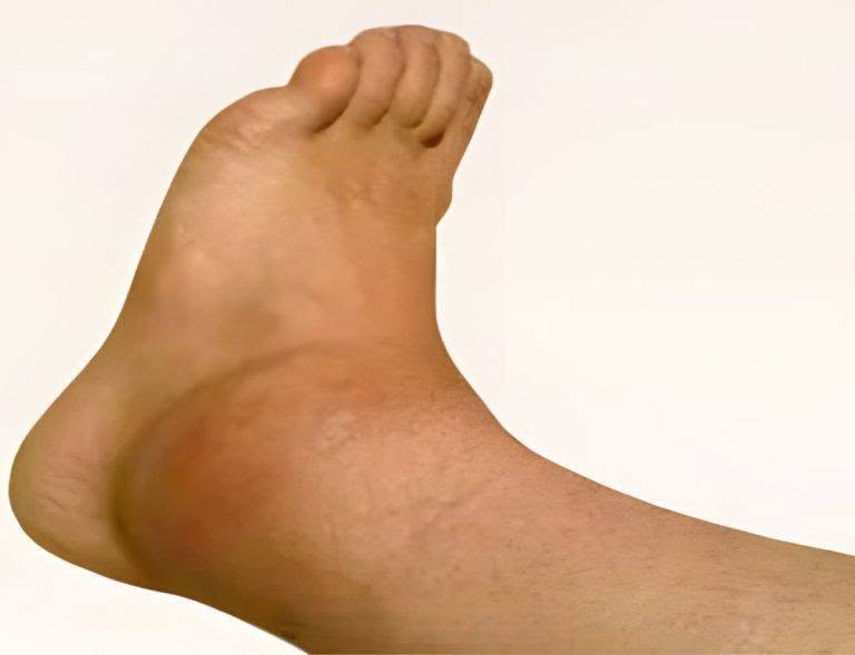 Swollen Ankles and Feet Explained: Causes Revealed!