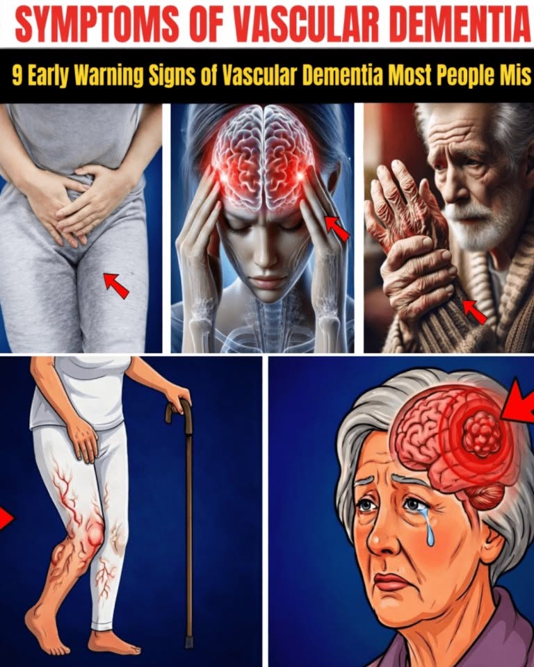 9 Early Signs of Vascular Dementia Most People Overlook – Especially Number 3