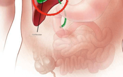 Gallbladder removal: What happens next and 3 risks to watch out for