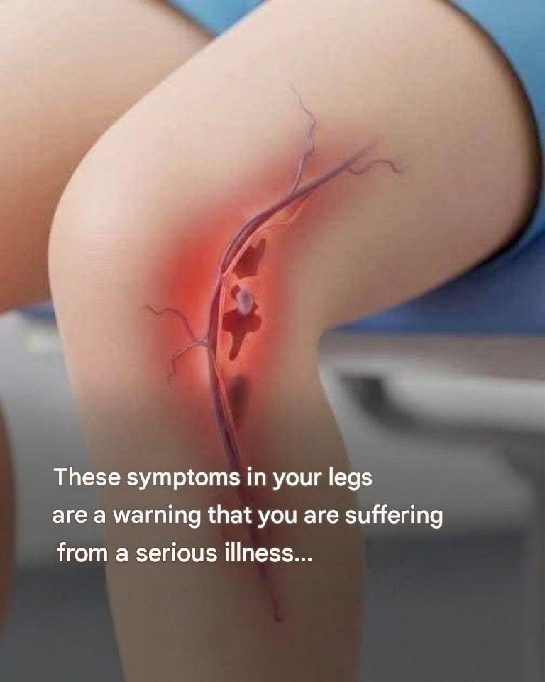 Warning signs of severe thrombosis. See more