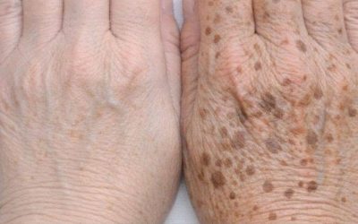 My mom taught me this trick to diminish dark age spots on my hands in just 3 mins with 0 effort. Here’s how it works