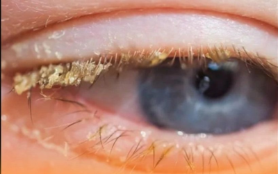 Yellow scab after waking up: what does it mean?